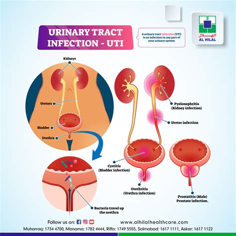 Urinary tract infection (UTI)